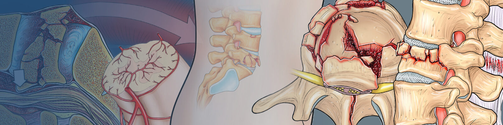 Animated Pictures Of The Spine Injuries