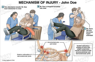 Mechanism of injury panel depicting improper transfer from wheelchair to chair, and subsequent trauma.