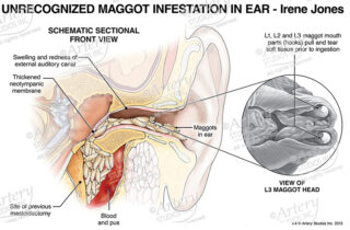 Panel depicting maggot infestation in ear.