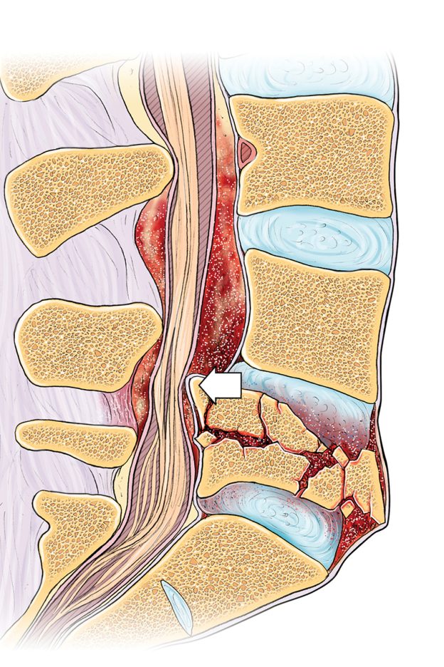 Illustration of trauma to the spinal cord.