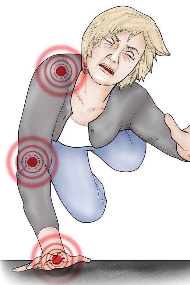 Illustration depicting a fall onto outstretched hand (FOOSH).