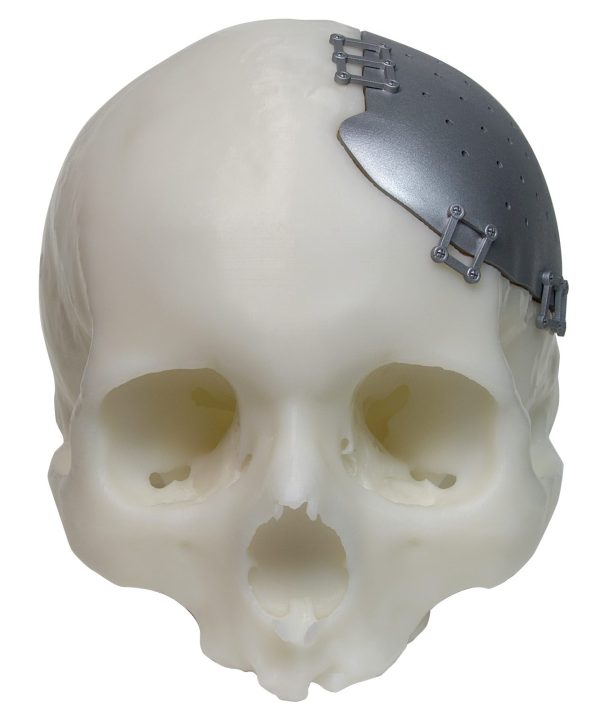 3D Model of Anterior Cranioplasty 3D Model of Anterior Cranioplasty